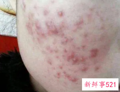 如何不长青春痘