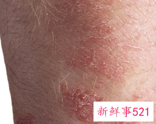 烫伤起泡怎么处理偏方