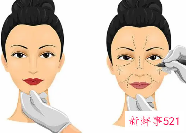 大拉皮手术15天了可以洗澡吗