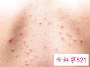 背上长粉刺怎么消除
