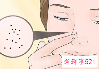 用食用盐可以去黑头吗