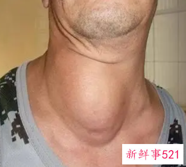 男性甲亢明显的症状