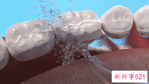 高压水枪洗牙结石