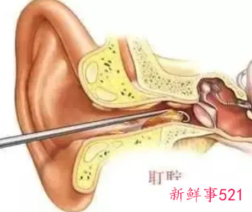 自己挖耳屎的技巧