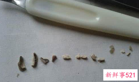 高压水枪洗牙结石