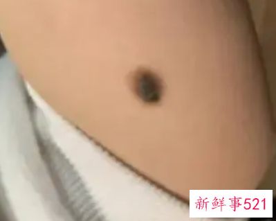 身上哪些痣有可能癌变