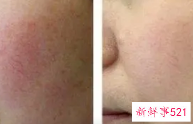 红血丝会随着年龄慢慢淡化吗