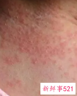 怎样判断过敏还是湿疹