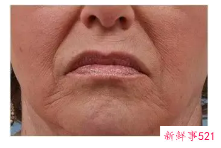皮肤松弛需谨慎