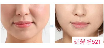 预防嘴角纹让你微微一笑也倾城