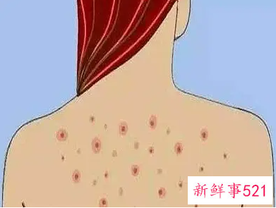 穿内衣的地方起疙瘩