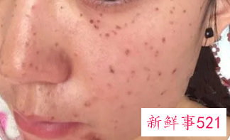 脸上有杂面星怎样祛除