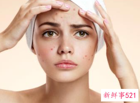 反复长痘痘的原因