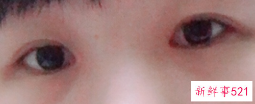 开眼角后可以抽烟吗