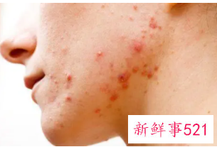 青春期脸上长痘痘调理