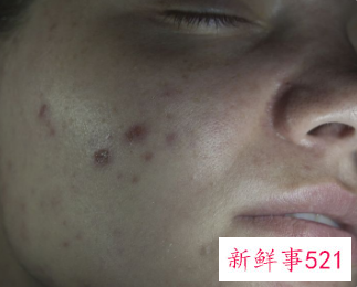 痘坑日常修复方法