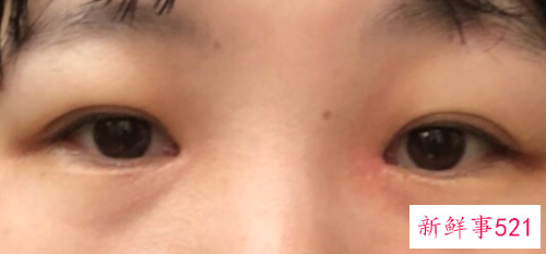 开眼角后可以抽烟吗