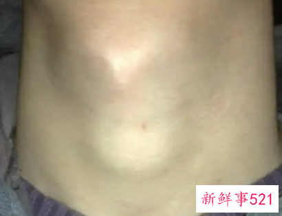 男性甲亢明显的症状