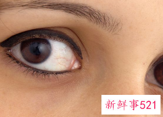 为什么一个双眼皮一个单眼皮