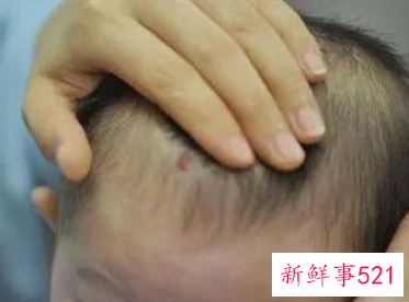 梦见头顶有疤是什么意思