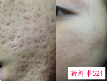 痘坑日常修复方法