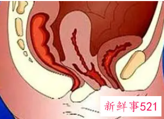子宫下垂是什么原因引起的