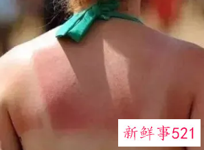 皮肤晒后变黄是为什么