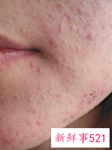 怎么做才能让痘痘粉刺消退