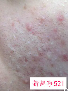 怎么做才能让痘痘粉刺消退