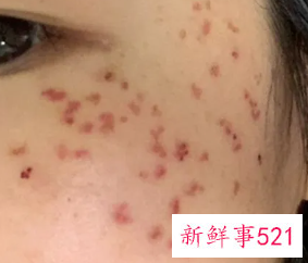 有关激光祛斑的7大偏见