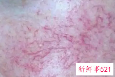 红血丝会随着年龄慢慢淡化吗