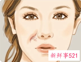 脸跌伤了怎样不留疤痕