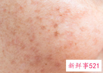 皮肤毛孔还粗大的解决方法