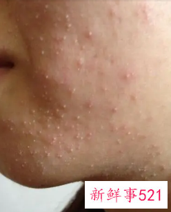 怎么做才能让痘痘粉刺消退
