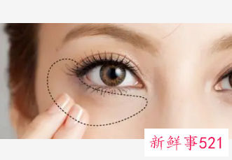 怎样去眼袋最有效啊
