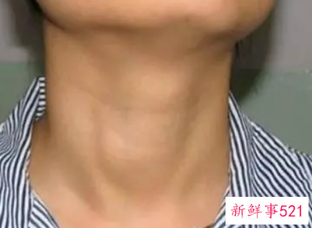 男性甲亢明显的症状