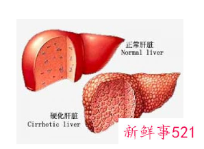 肝硬化的形成原因
