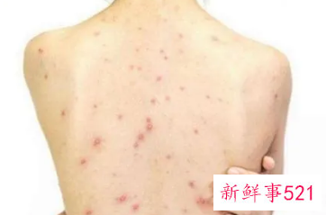 背上长粉刺怎么消除