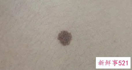 身上哪些痣有可能癌变