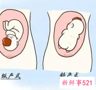 胎位不正怎么调整