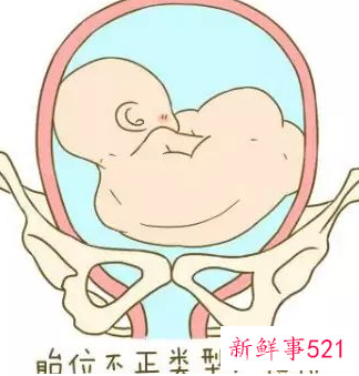 胎位不正怎么调整