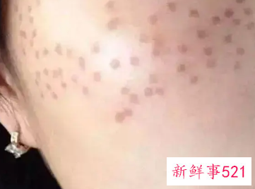 有关激光祛斑的7大偏见