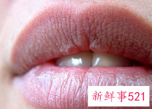 冬季嘴皮干裂是什么原因