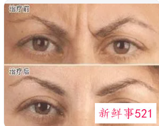 川字纹打玻尿酸能维持多久