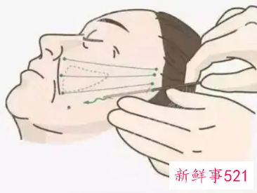 大拉皮手术15天了可以洗澡吗