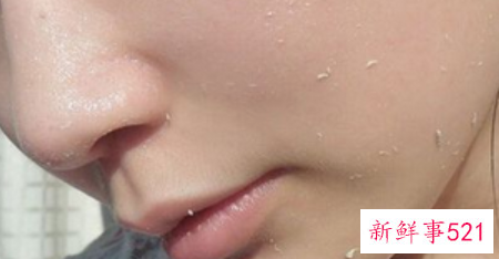 为什么总是长脂肪粒