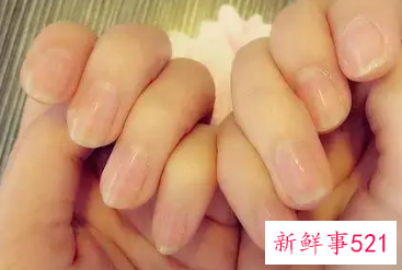 手指色素沉淀怎么办