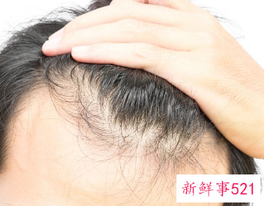 hbw毛囊克隆植发