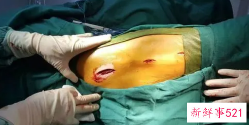 手术后怎么恢复最快