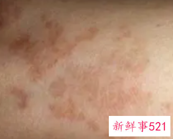 脸上有杂面星怎样祛除